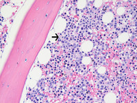 Paroxysmal Nocturnal Hemoglobinuria-H&E Low Power