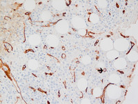 Paroxysmal Nocturnal Hemoglobinuria-CD34