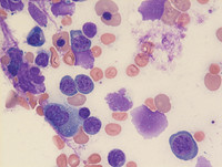 Paroxysmal Nocturnal Hemoglobinuria-Marrow Aspirate