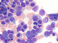 Paroxysmal Nocturnal Hemoglobinuria-Marrow Aspirate