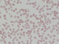 Paroxysmal Nocturnal Hemoglobinuria-Blood