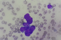 Presence of LE cells in Bone Marrow