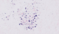 Extracavitary Primary Effusion Lymphoma-EBER