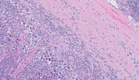 Extracavitary Primary Effusion Lymphoma-H&E High Power