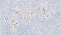 Extracavitary Primary Effusion Lymphoma-HHV8