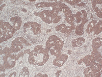 Nodal Follicular Lymphoma-BCL2