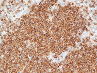 Nodal Follicular Lymphoma-BCL2