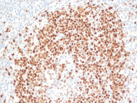 Nodal Follicular Lymphoma-BCL6