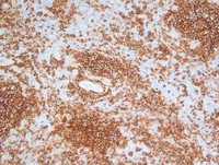 Nodal Follicular Lymphoma-CD20