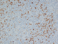 Nodal Follicular Lymphoma-C-Myc