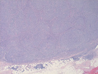 Nodal Follicular Lymphoma-H&E Low Power