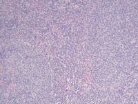 Nodal Follicular Lymphoma-H&E Low Power