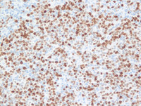 Nodal Follicular Lymphoma-Ki67
