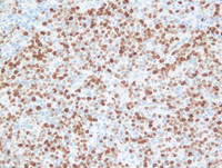 Nodal Follicular Lymphoma-Ki67