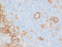 Nodal Follicular Lymphoma-PDL1