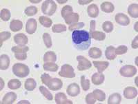 Chronic Lymphoproliferative Disorder of NK Cells - Blood