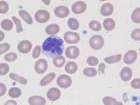 Chronic Lymphoproliferative Disorder of NK Cells - Blood