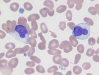 Chronic Lymphoproliferative Disorder of NK Cells - Blood