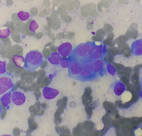 Abnormal plasma cell with multiple nucleoli