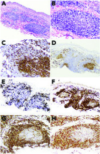 Cutaneous composite small lymphocytic lymphoma and primary cutaneous follicle center lymphoma