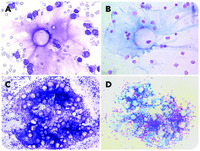 A gelatinous leukemia