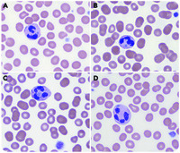 Pay attention to neutrophil inclusions in pediatric patients with thrombocytopenia