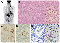 Hodgkin and Reed-Sternberg–like cells infected with human T-cell leukemia virus type 1