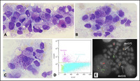 Promyelocytic leukemia with basophil-like granules