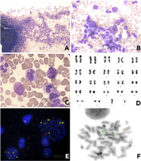 Double translocation or gene insertion? A BCR/ABL1 fusion in Philadelphia-negative CML